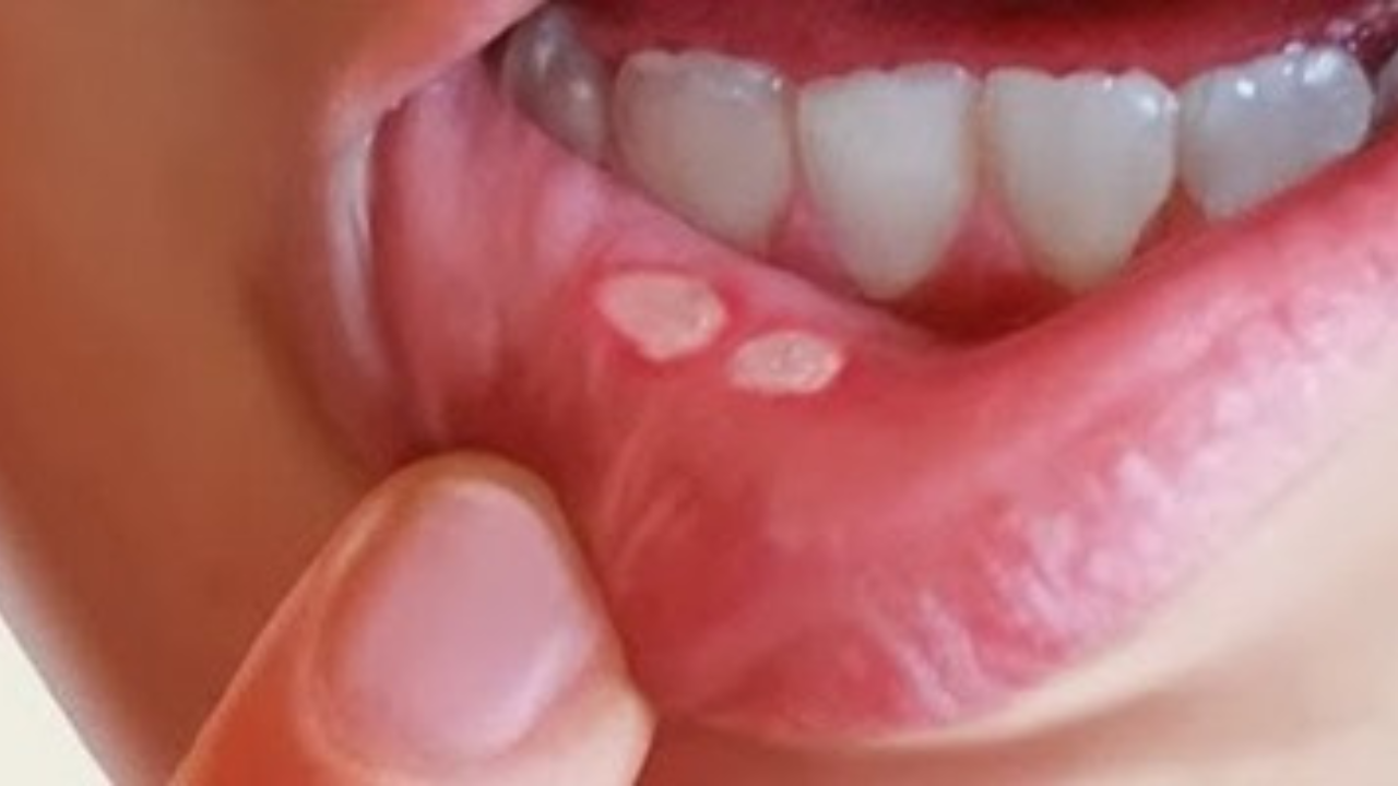 وصفة الدكتور جمال الصقلي لعلاج تقرحات الفم